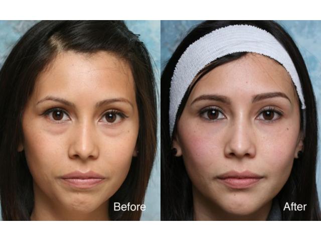 BUEC - eye bag removal in Singapore
