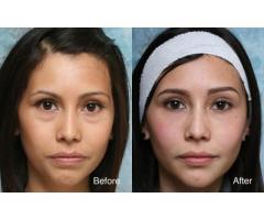 BUEC - eye bag removal in Singapore
